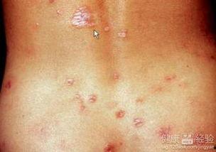 吃瓜梅毒事件,揭秘网络谣言背后的真相